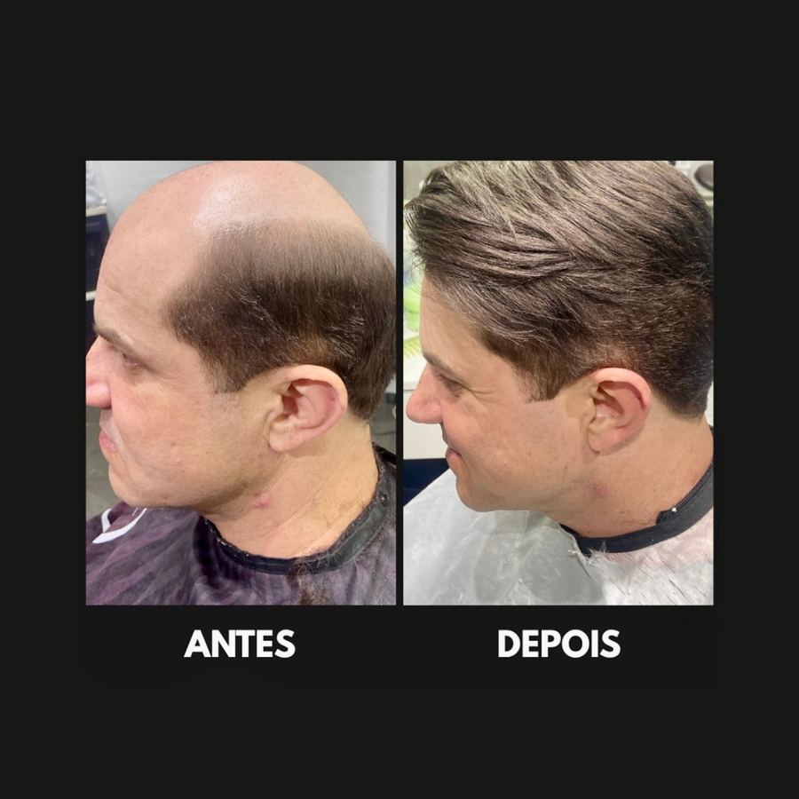 Cliente Satisfeito com Prótese Capilar em SP